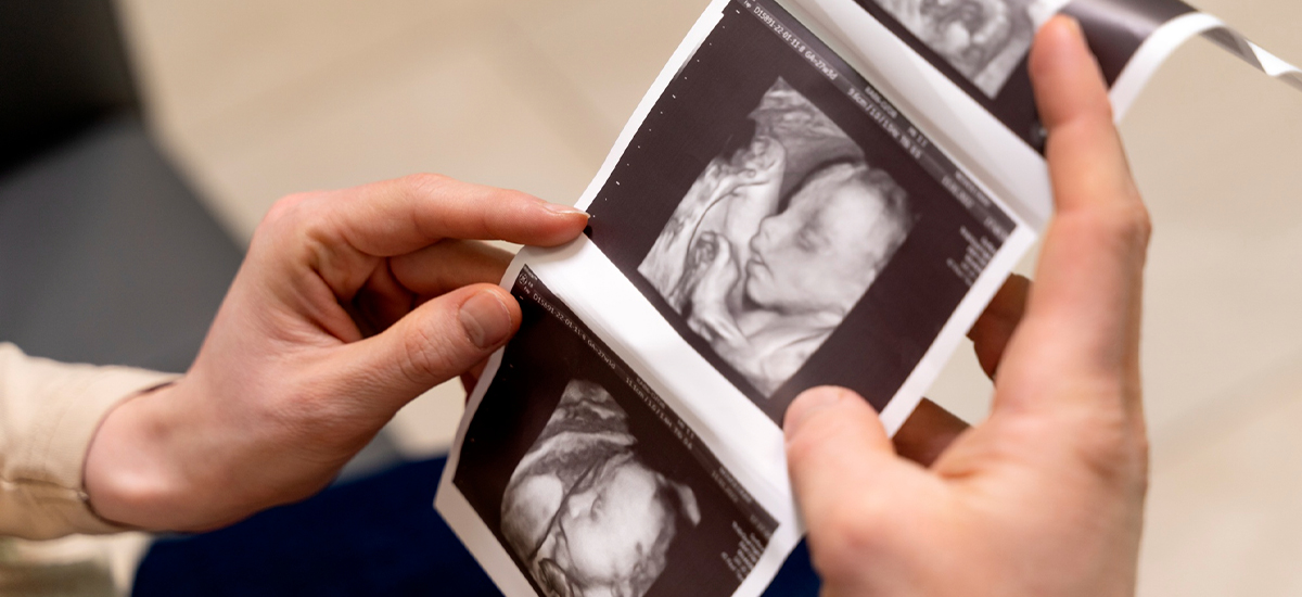 Signs of Down Syndrome During Pregnancy: What You Can Know, Stage by Stage